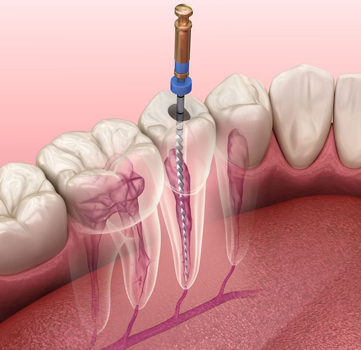 Rotary Root Canal Treatment